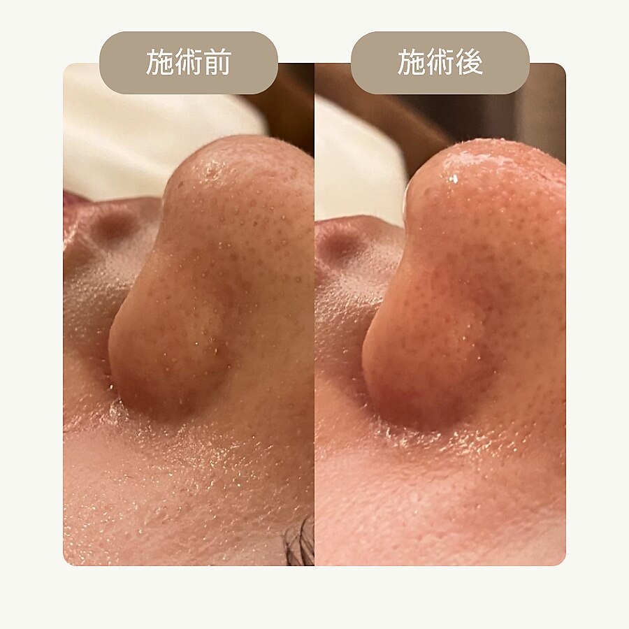 毛穴洗浄の施術前・施術後